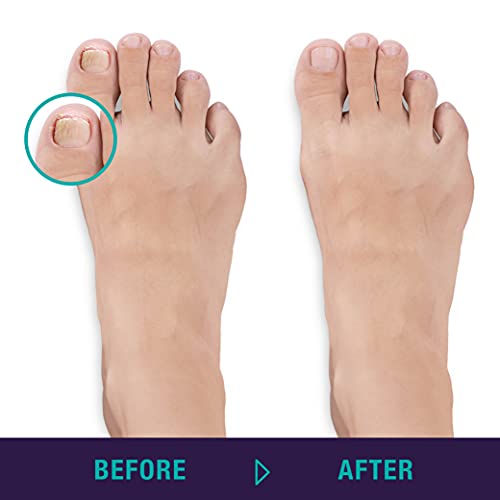 Trim Simply Foot Ingrown Toenail Kit - Includes Stainless Steel Toenail Nipper and Stainless Steel Dual-Ended File - Professional Foot Care Set for Salon Quality Grooming - Easy-to-Use - 2 Piece Set