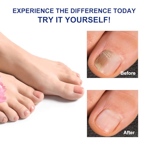 Toenail Treatment Extra Strength-8-Hrs Overnight Nail Repair,ingrown toenail treatment,Strengthens Brittle Nails,Improves Texture & Thickening Hypoallergenic Easy (2 pack 64 Patch)
