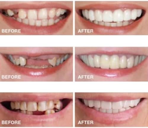 2 Pairs, Temporarily Adjustable for Men and Women, Regain Confidence