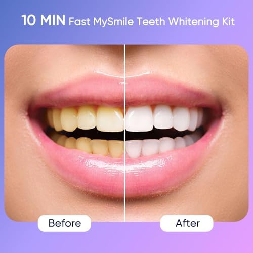 MySmile Deluxe 10 Min Teeth Whitening Kit with 28 LED Light, 35% Carbamide Peroxide Teeth Whitening Gel, Helps Remove Years of Stains from Coffee, Soda, Wines, Smoking, Food
