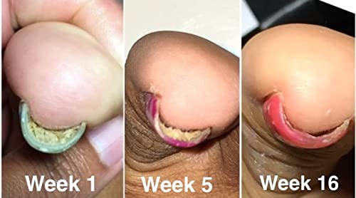 Probelle Natural Fungal Nail Oil, Nail Color Restoration, Clear Topical Solution .5 oz/ 15 ml