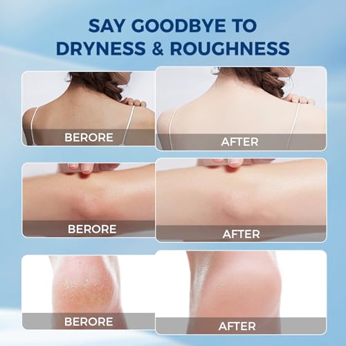 OUKEYA Urea Cream 40 Percent for Feet Maximum Strength,Foot Cream for Dry Cracked Heels and Feet,Urea Moisturizer,Foot Repair Cream,Foot and Hand Cream,5.29 oz