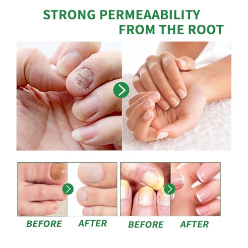 3PCS Ginger Nail Treatment, Ginger Cuticle Care Oil for Nails, Multi-Purpose Nail Repair Nutrient Oil (02)