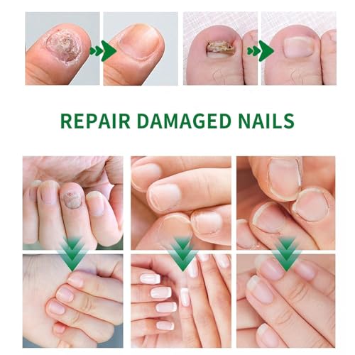 7 days Nail Growth Serum, 2PCS 7 Days Ginger Nail Essence, Multi-Purpose Nail Repair, Nail Nutrient Oil Strengthener Oil (2pcs)