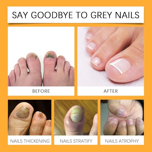 Bee Venom Nail Care Spray, Bee Venom Nail Soothing Spray, Toe Nail Treatments for Damaged Nails, Nail care, Safely and Gently