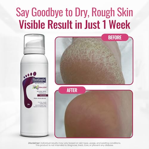 Footlogix Rough Skin Formula with Spiraleen - Mousse for Dry Cracked Heels and Feet, Foot Care for Men and Women, Dry Cracked Feet Treatment, 4.23oz
