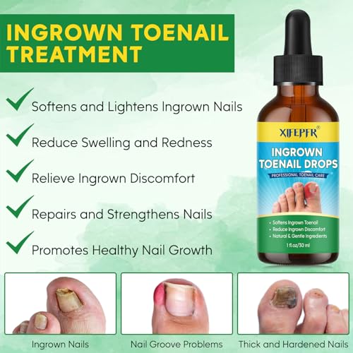 Ingrown Toenail Tools Kit, Ingrown Toenail Treatment, Stainless Steel Ingrown Toenail Removal Kit, Ingrown Toenail Corrector, Corrector Patch, Toenail Clipper, Nail File Lifter Pedicure Tool