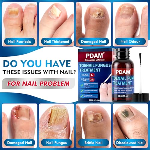 Toenail Fungus Treatment Extra Strength - Toe Nail Fungus Treatments for Thick, Nail Strengthener and Growth, Nail Fungus Treatment Extra Strength for Broken, Discolored Nail & Ingrown Toenail - 30ml