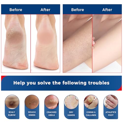 OUKEYA Urea Cream 40 Percent for Feet Maximum Strength,Foot Cream for Dry Cracked Heels and Feet,Urea Moisturizer,Foot Repair Cream,Foot and Hand Cream,5.29 oz