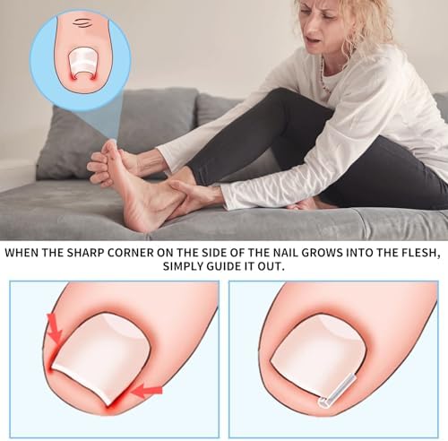 Ingrown Toenail Removal Kit Includes Ingrown Toenail Corrector, Tweezer, 50pcs Nail Patches,12 Nail Retainer,10 Toenail Corrector Strips