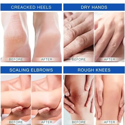 Urea Cream 45% Plus 2% Salicylic Acid, Callus Remover Foot Moisturizer Hand Foot Cream For Dry Cracked Feet from Toes to Heels Elbows Knees Softens Skin Exfoliates Dead Skin Smoothing Skin