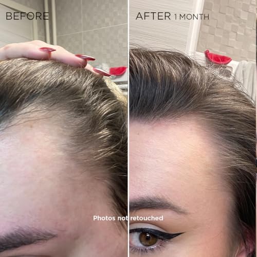 PHYTOCYANE WOMEN TREATMENT REACTIONAL HAIR THINNING