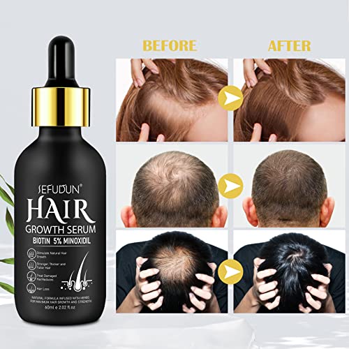2Pack 5% Minoxidil for Men and Women Hair Growth Serum, Biotin Infused Hair Regrowth Treatment for Beard & Scalp Hair Loss & Thinning, Promotes Thicker, Fuller, Healthier Hair - 4.04 oz