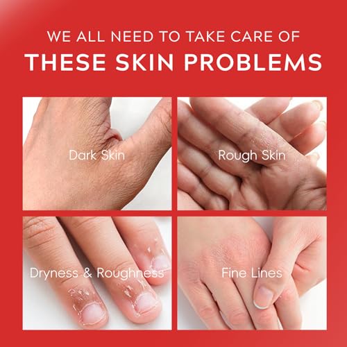 𝑲𝒐𝒋𝒊𝒄 𝑨𝒄𝒊𝒅 Hand Cream, 𝑲𝒐𝒋𝒊𝒄 𝑨𝒄𝒊𝒅 Hands Cream for Women & Girls Dry Cracked Hands Hyaluronic Acid Tender Cream 30g Pack of 5