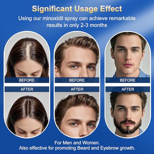 5% Minoxidil for Men & Women | Hair Growth Oil Spray | 5-Pack (17.5 fl oz) | 8 Month Supply | Hair Regrowth & Beard Growth Treatment with Biotin | Clinically Proven Extra Strength Formula