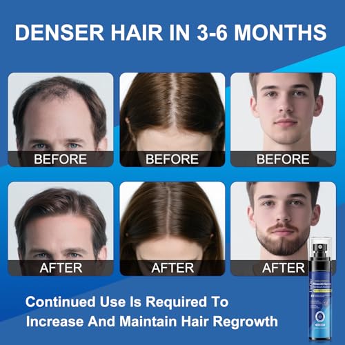 5% Minoxidil Spray for Men and Women, Infused with Biotin, for Hair Regrowth Treatment, Beard Growth, Extra Strength Treatment to Combat Hair Loss and Thinning, 5 Month Supply, 3 x 3.38 oz
