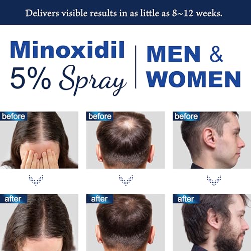 5% Minoxidil for Men Hair Growth Spray for Men and Women (180ml)