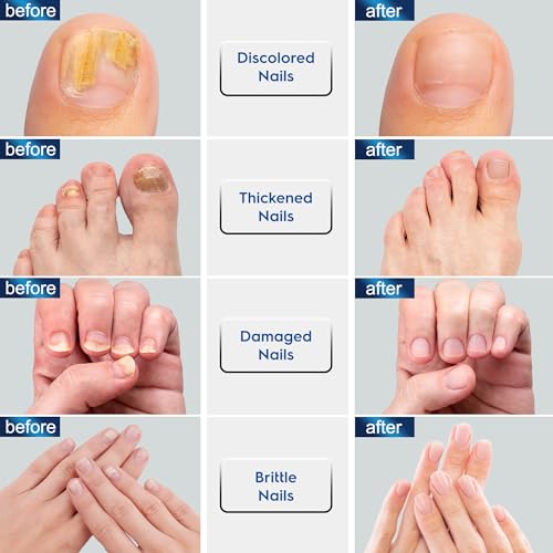 Toenail Fungus Treatment Extra Strength, Fungus Treatment for Toenails and Fingernails with Natural Oils, Toe Nail Fungus Treatment for Men and Women 2pcs., Blue