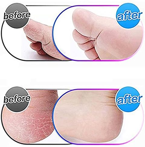 6 Pack Blue Extra Coarse Replacement Roller Refills Compatible with Scholl Express Pedi Foot Smoother Include a Cleaning Brush