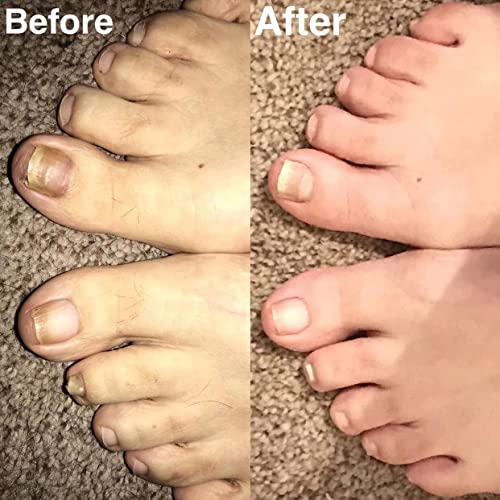 Probelle Natural Fungal Nail Oil, Nail Color Restoration, Clear Topical Solution .5 oz/ 15 ml