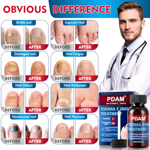 Toenail Fungus Treatment Extra Strength - Toe Nail Fungus Treatments for Thick, Nail Strengthener and Growth, Nail Fungus Treatment Extra Strength for Broken, Discolored Nail & Ingrown Toenail - 30ml