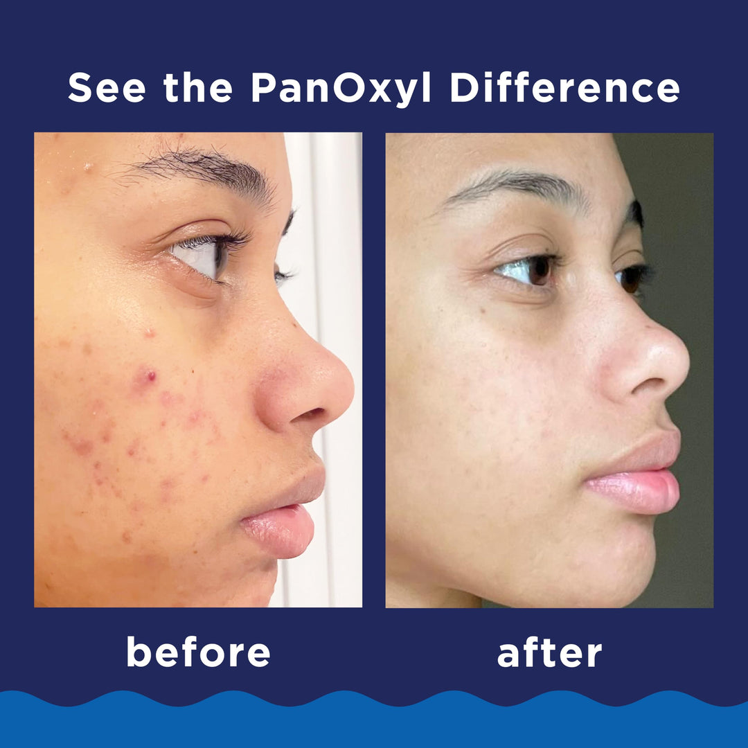 PanOxyl Acne Foaming Wash Benzoyl Peroxide 10% Maximum Strength Antimicrobial, 3 oz. - Travel Size