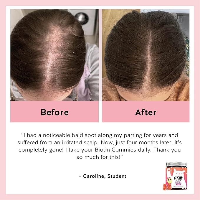 Biotin Gummies for Hair, Skin & Nails. 5,000 mcg High Potency Vegan Vitamins for Faster Hair Growth, Stronger Nails & Healthy Skin. with Vitamins C & E, 90 Gummies