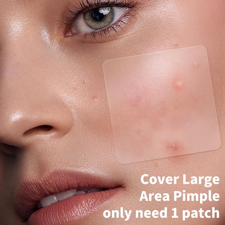 Hydrocolloid Pimple Patches | 510 Count Acne Spot Stickers with Salicylic Acid & Tea Tree Oil