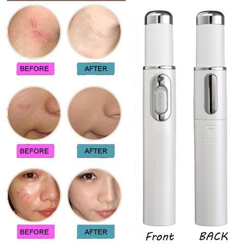 Blue Light Therapy Acne Pen