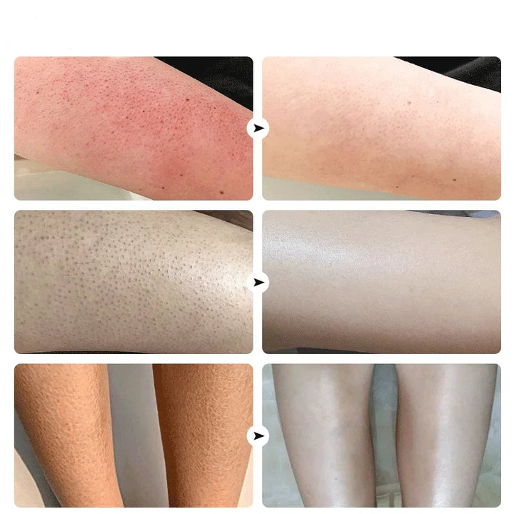 Curing Keratosis Pilaris Chicken Follicle Skin Repair Cream Body Dark Spot Remove Whiten Smooth Moisturize Skincare Body Lotion