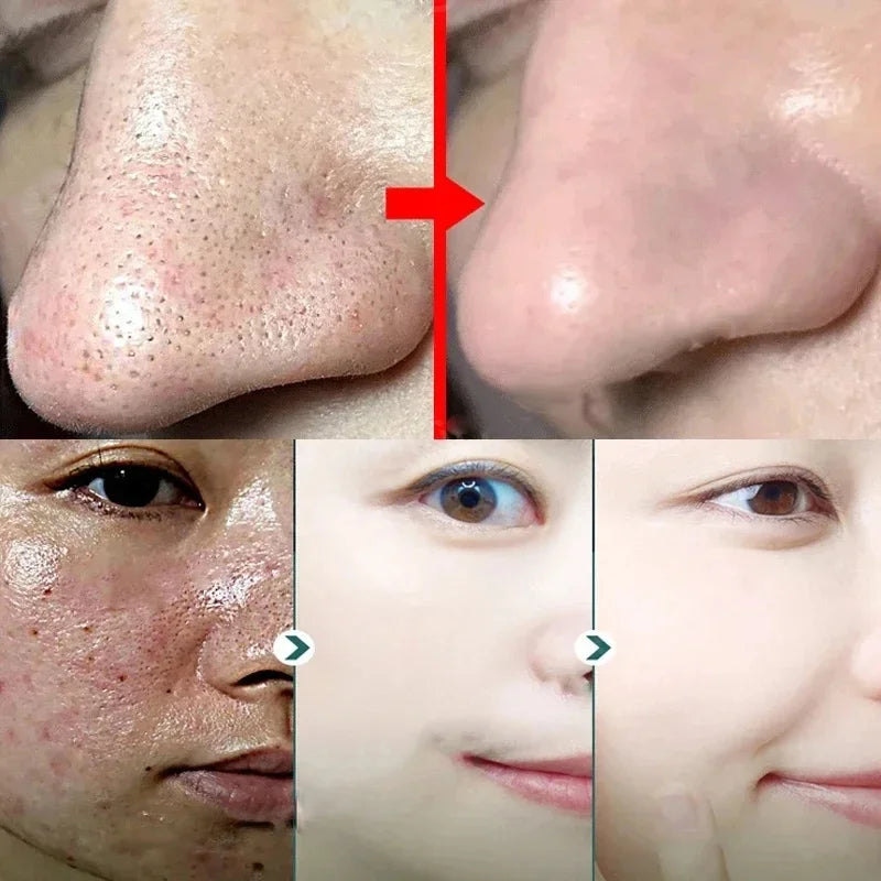 Original Facial Remove Blackhead Green Tea Solid Mask Treat Acne Blemish Black Dots Clean Stick Cream Shrink Pores Skin Care