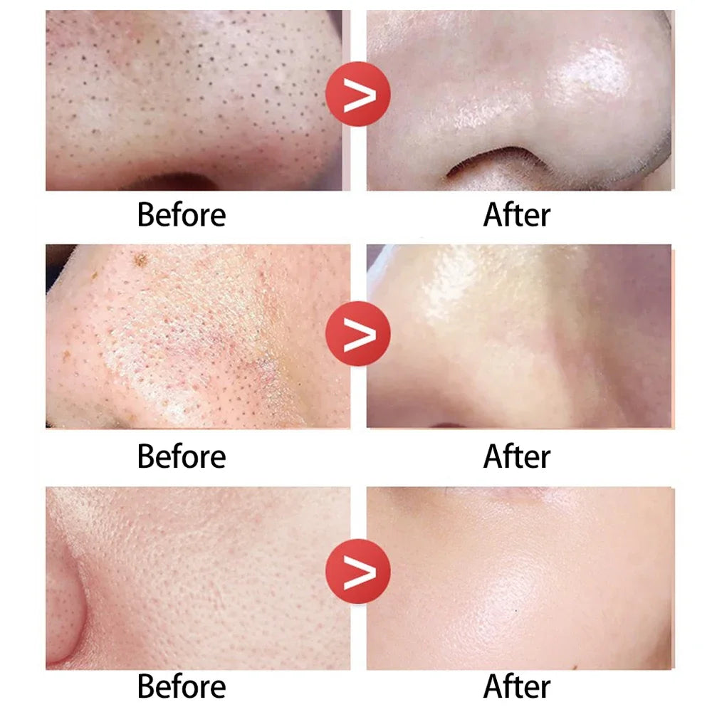 Peel Off Nose Blackhead Remover Strips Deep Cleansing Shrink Pore Acne Treatment Mask Nose Patches Face Skin Care Beauty Tools