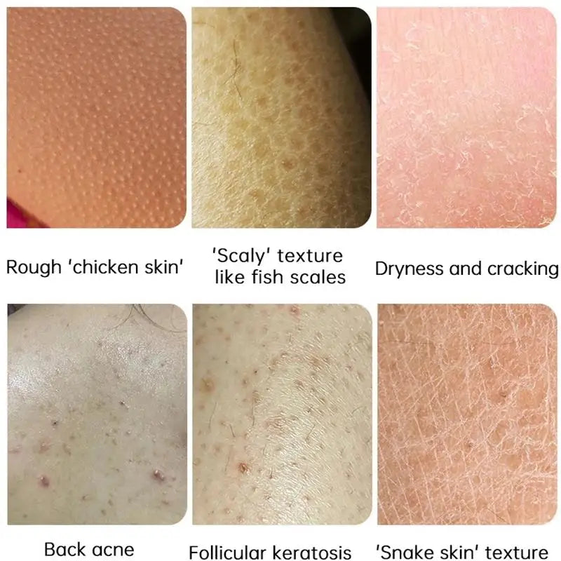 Curing Keratosis Pilaris Chicken Follicle Skin Repair Cream Body Dark Spot Remove Whiten Smooth Moisturize Skincare Body Lotion