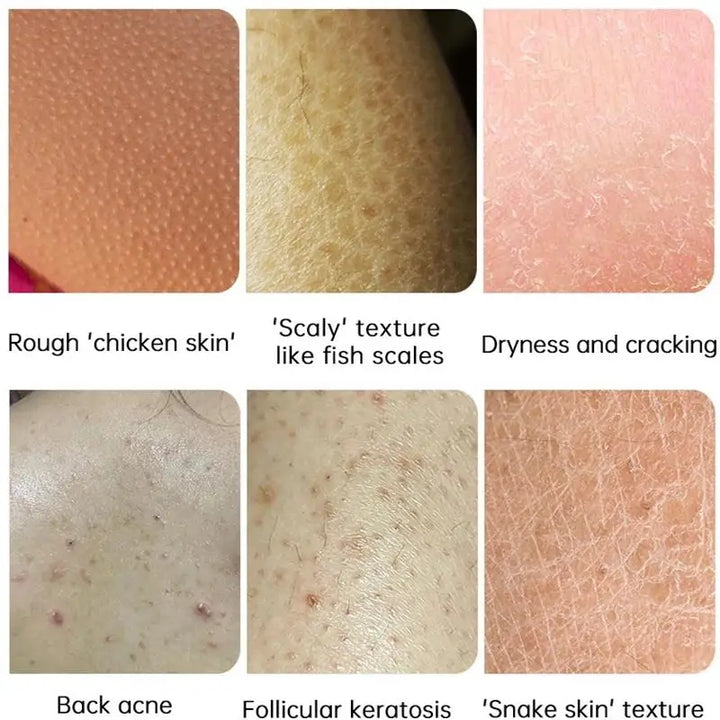 Curing Keratosis Pilaris Chicken Follicle Skin Repair Cream Body Dark Spot Remove Whiten Smooth Moisturize Skincare Body Lotion