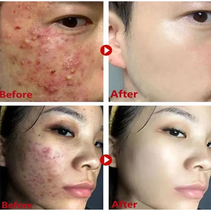 Original Facial Remove Blackhead Green Tea Solid Mask Treat Acne Blemish Black Dots Clean Stick Cream Shrink Pores Skin Care
