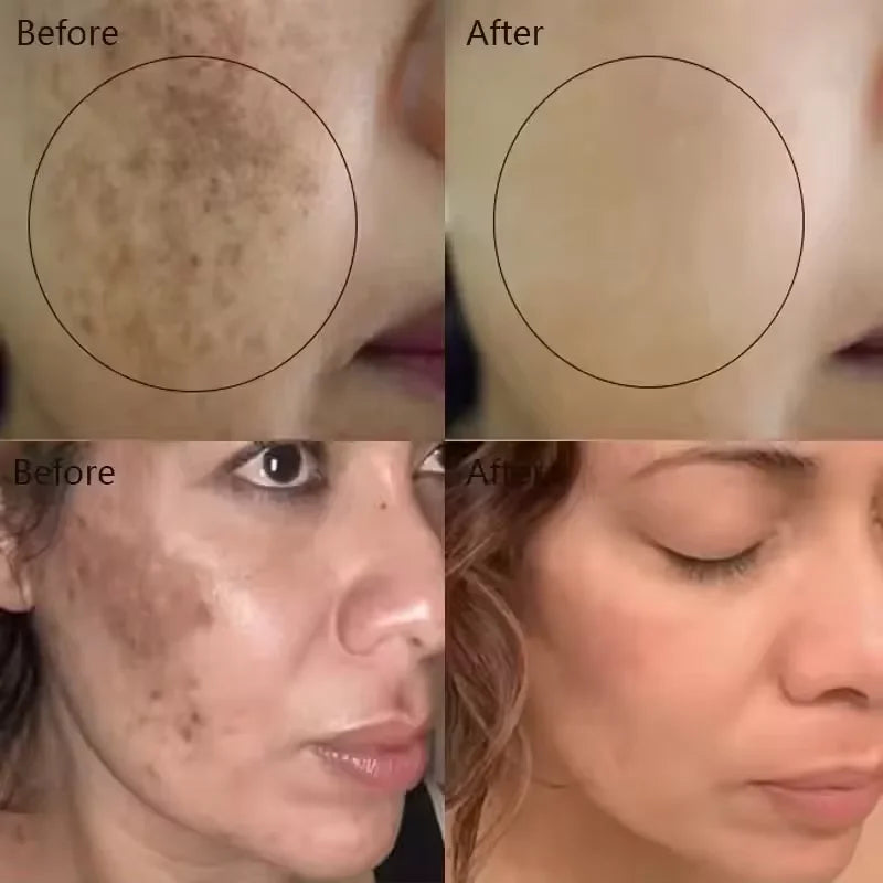 Vitamin C Whitening Freckles Serum Remove Dark Spots Freckles Fade Melanin Nicotinamide Essence Brighten Moisturizing Skin Care