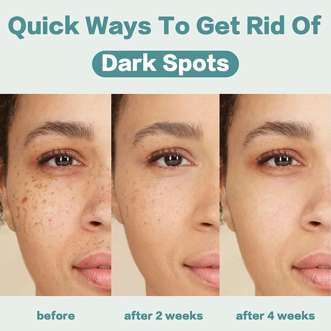 Effective Whitening Freckles Face Cream Remove Melasma Dark Spots Fade Pigmentation Acne Scars Moisturizing Brighten Beauty Care