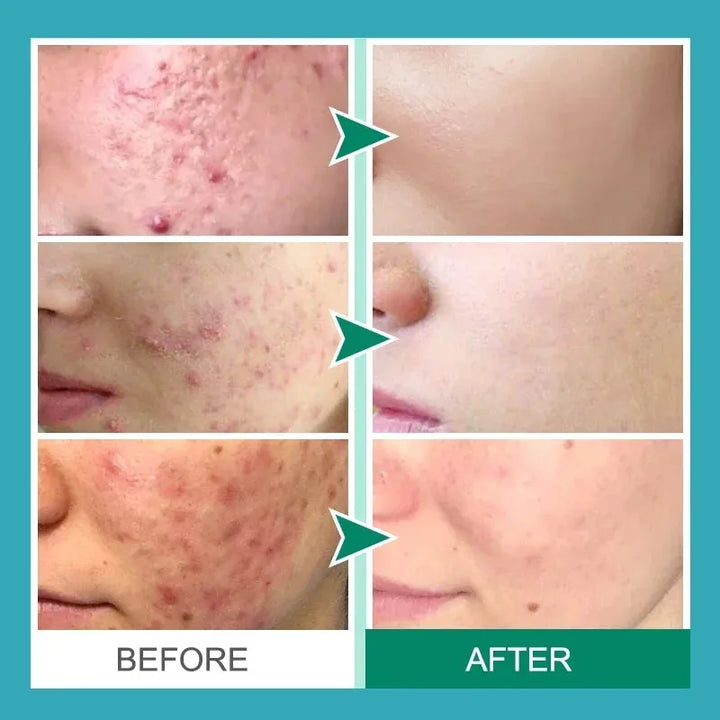Salicylic Acid Acne Treatment Cream Shrink Pore Remove Blackheads Scars Acne Marks Spots Oil Control Whitening Korean Skin Care