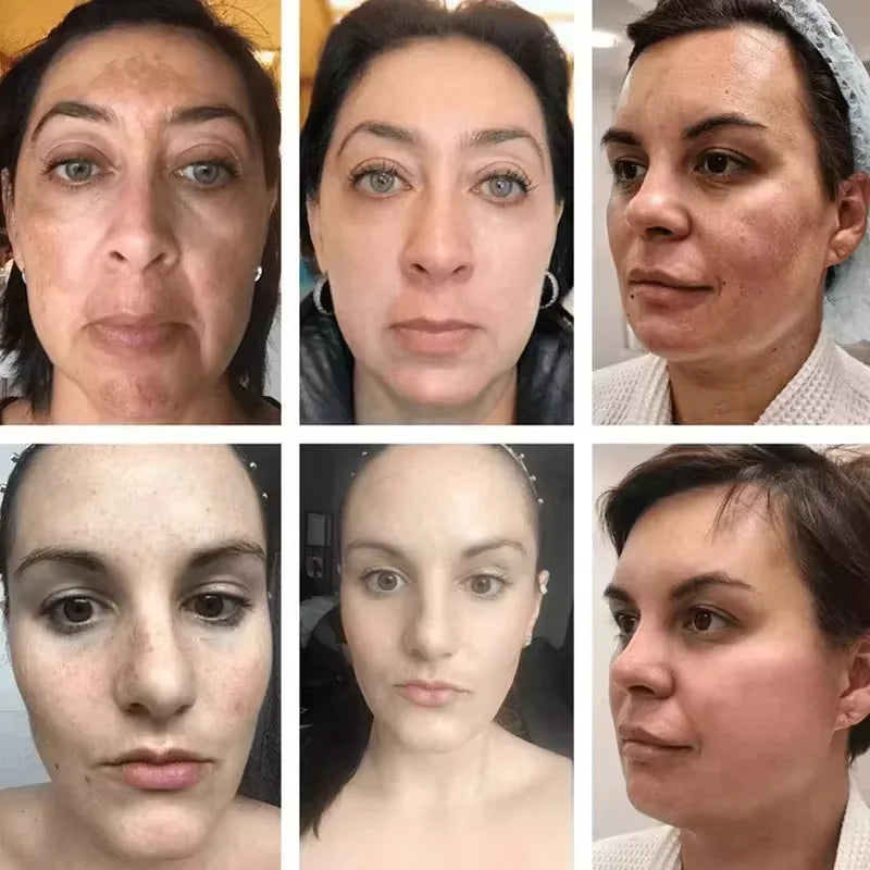 Vitamin C Whitening Freckles Serum Remove Dark Spots Freckles Fade Melanin Nicotinamide Essence Brighten Moisturizing Skin Care