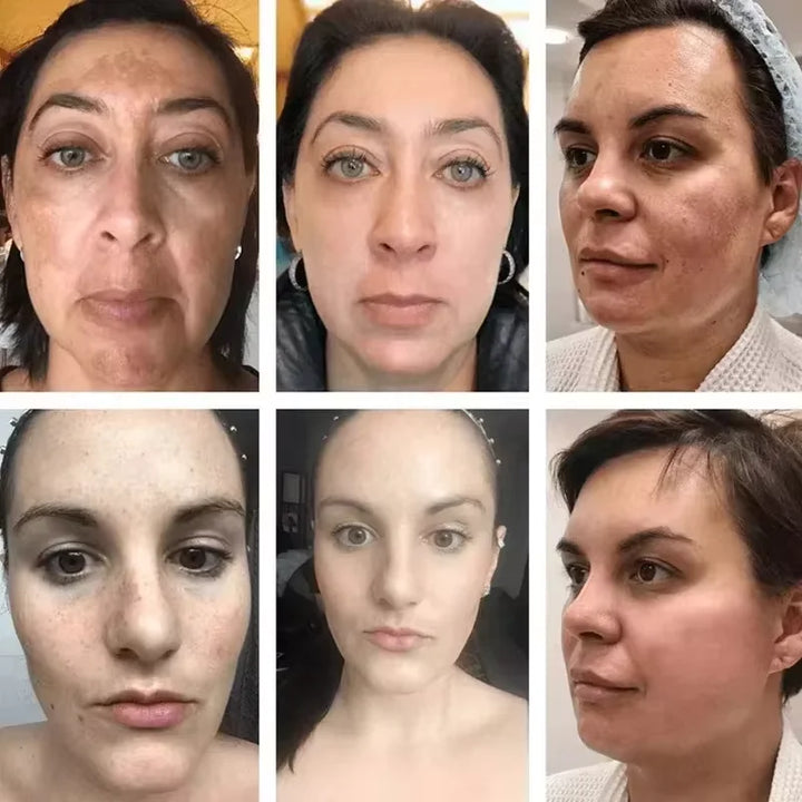 Vitamin C Whitening Freckles Serum Remove Dark Spots Freckles Fade Melanin Nicotinamide Essence Brighten Moisturizing Skin Care