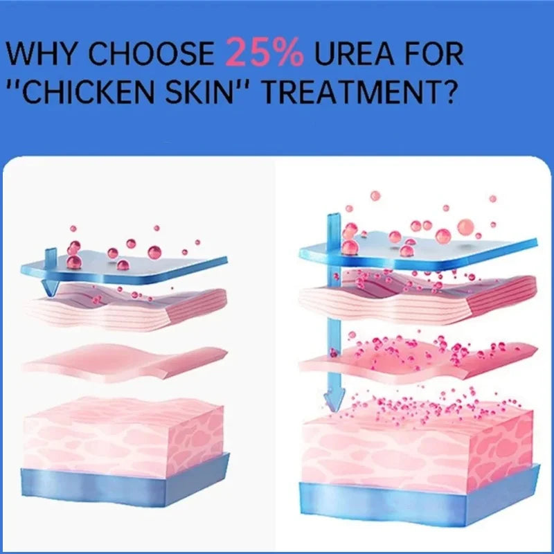 Curing Keratosis Pilaris Chicken Follicle Skin Repair Cream Body Dark Spot Remove Whiten Smooth Moisturize Skincare Body Lotion