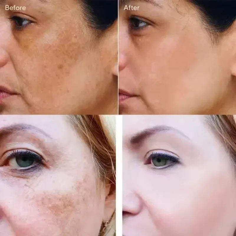 Vitamin C Whitening Freckles Serum Remove Dark Spots Freckles Fade Melanin Nicotinamide Essence Brighten Moisturizing Skin Care