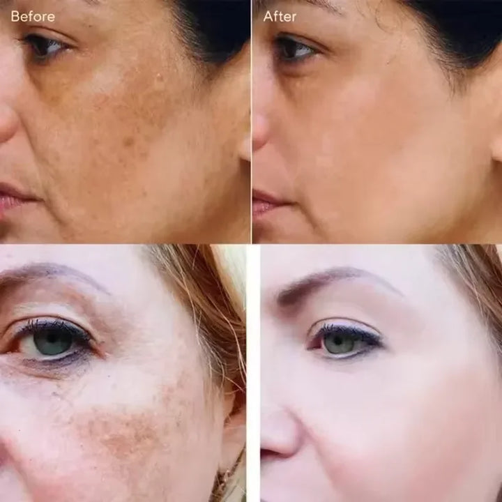 Vitamin C Whitening Freckles Serum Remove Dark Spots Freckles Fade Melanin Nicotinamide Essence Brighten Moisturizing Skin Care